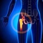 علائم شکستگی لگن در سالمندان چیست و چگونه درمان می‌شود؟